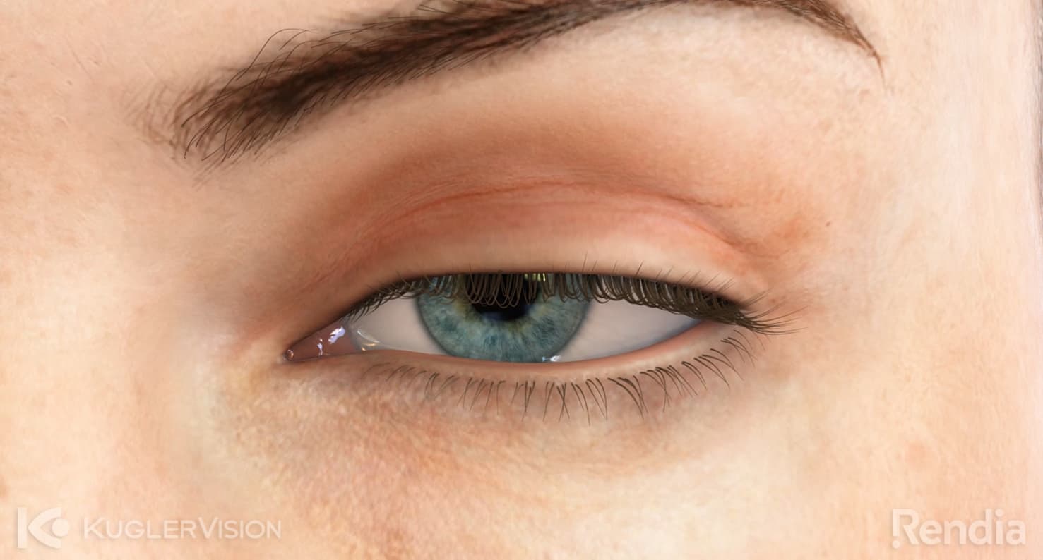 ptsosis eye condition