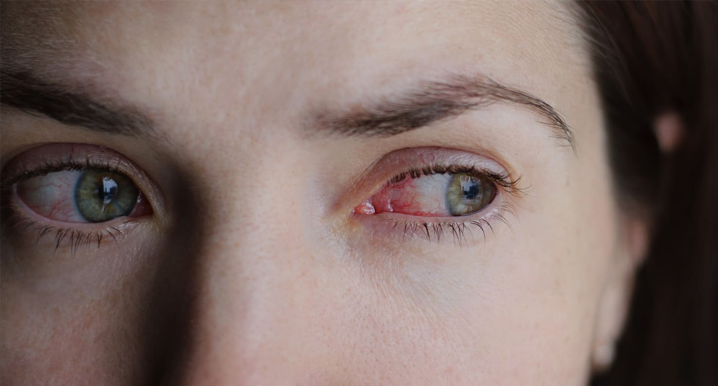 woman who has red eyes from contact lens-related infection
