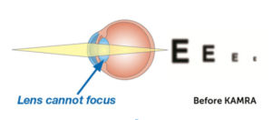 eye diagram before kamra inlay