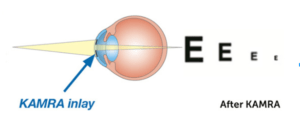 eye diagram after kamra inlay