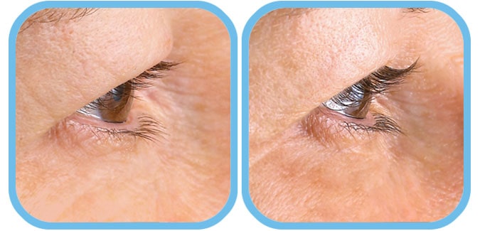 alphaeon eyelash serum before and after results