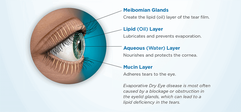 dry-eye-information-what-causes-dry-eye-kugler-vision