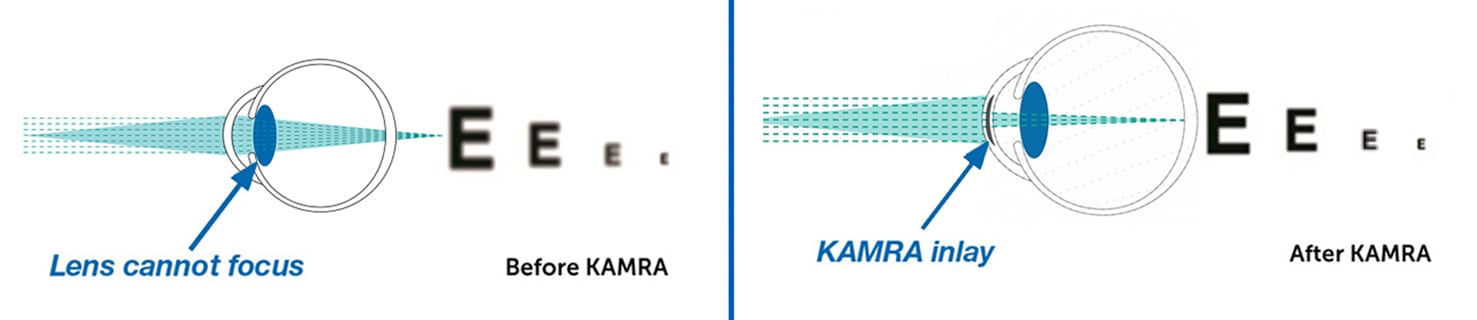 kamra inlay vision comparison