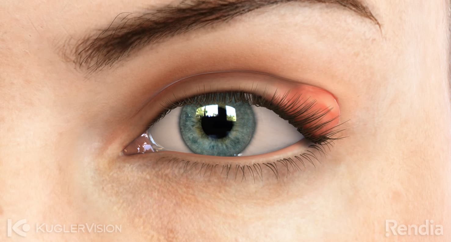chalazion eye condition