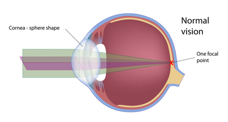 What Is Astigmatism And How Can It Be Treated? – Kugler Vision