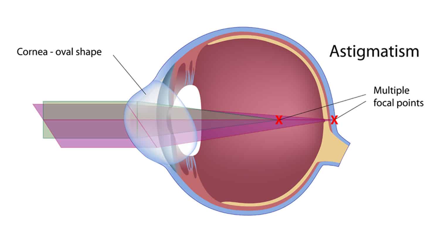 Astigmatism