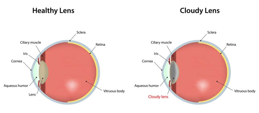 what-is-a-cataract-kugler-vision