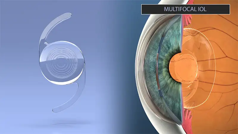 multifocal and trifocal lenses